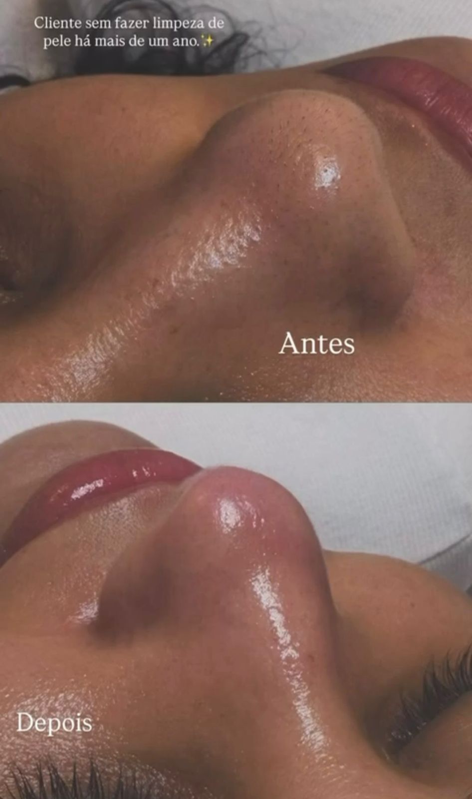 Limpeza de pele premium - resultado do procedimento