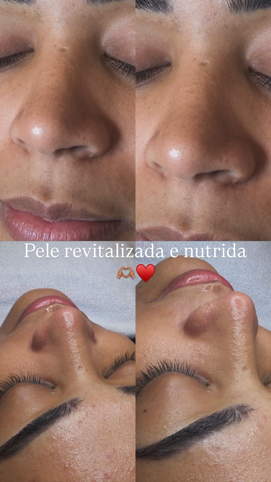 Revitalização Facial - resultado do procedimento